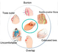 Toe separators and spreaders for Bunion, Overlapping Toes and Drift Pain [PAIR] - Offer Hunts